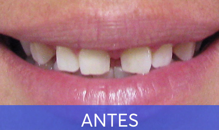 antes1