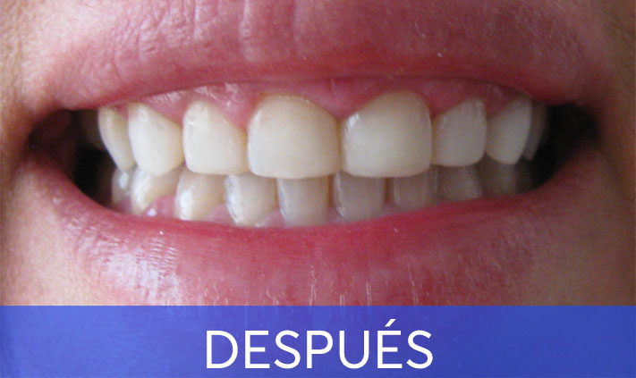 despues11